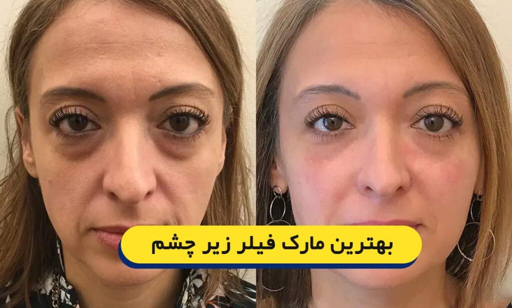 بهترین مارک فیلر زیرچشم