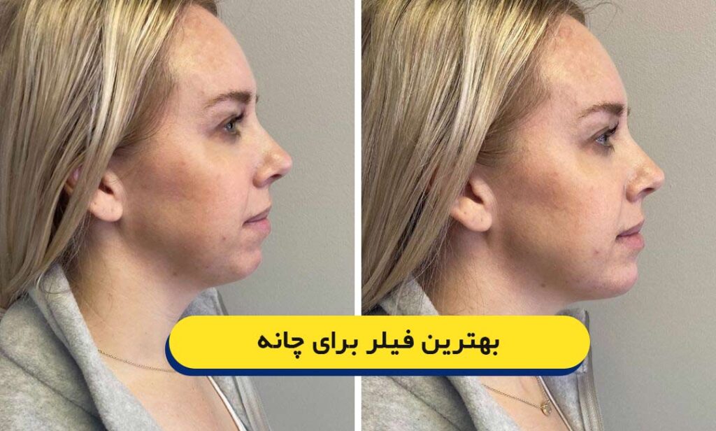 بهترین فیلر برای چانه
