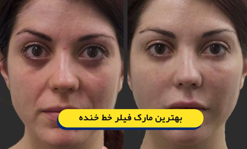 بهترین فیلر خط خنده