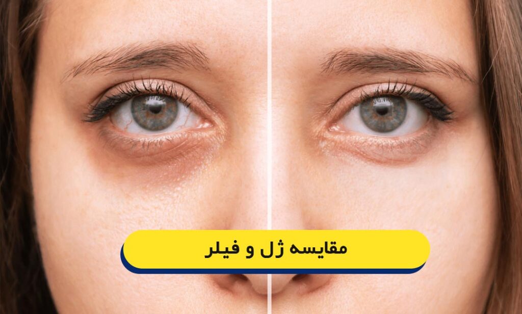 مقایسه ژل و فیلر